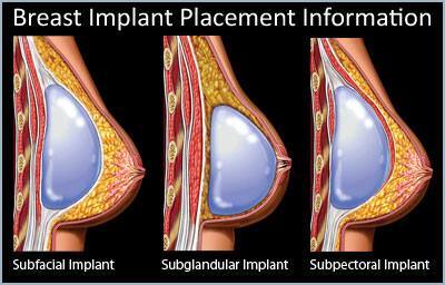 Breast Enlargement & Shaping Pump Non Surgical Enhancement Device