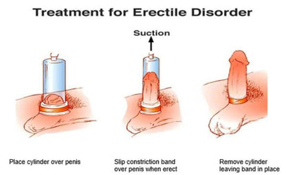 Vacuum Erection Pump for Men  Performance Support Device