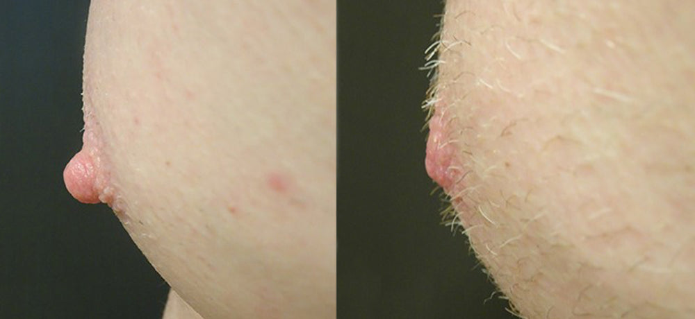 Natural Nipple Enlargement Solution